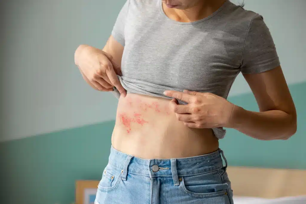 Shingles Treatment